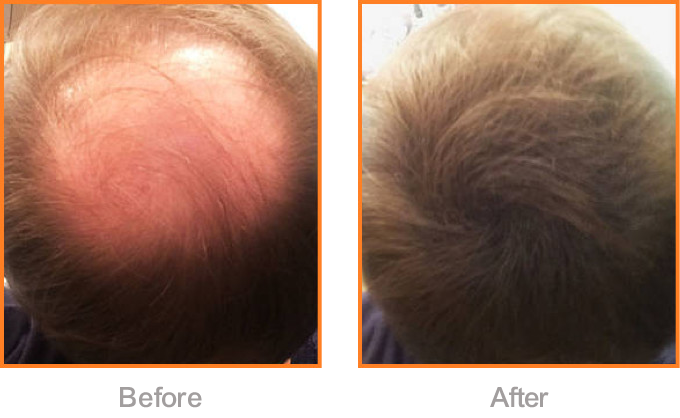 Choosing the right hair fiber product is&nbsp;crucial for achieving natural-looking, long-lasting results.
