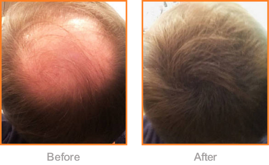 Choosing the right hair fiber product is&nbsp;crucial for achieving natural-looking, long-lasting results.