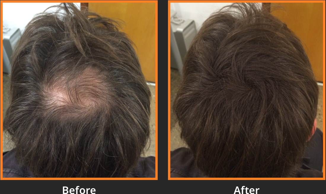 How Hair Fibers Are a Game-Changer for Thinning Hair