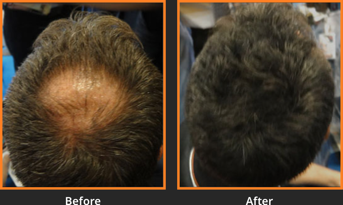 Hair Fibers vs. Hair Transplants: Which Solution Is Right for You?